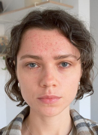 Microneedling Prices in Islamabad