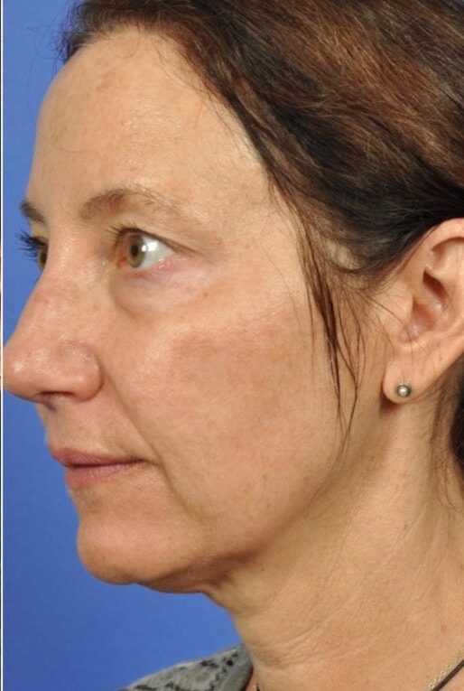 Microneedling Treatment Islamabad