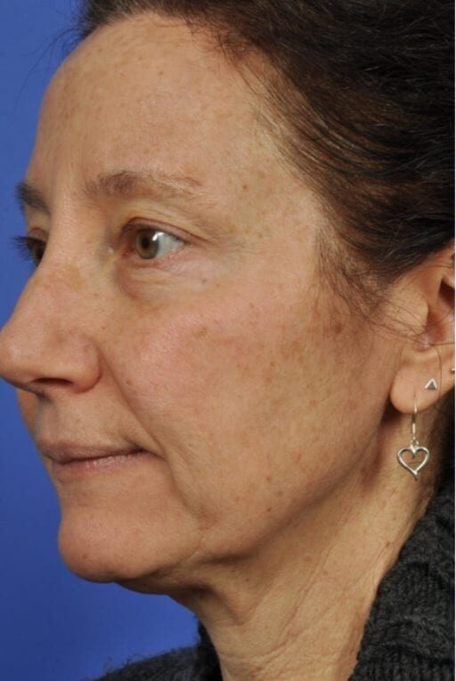 Microneedling Treatment Islamabad