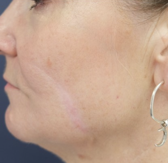 Surcical Scar Revision