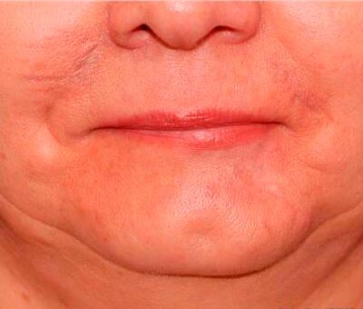 Surcical Scar Revision Islamabad