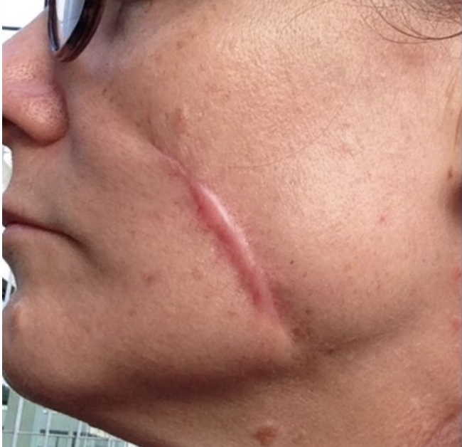Surcical Scar Revision