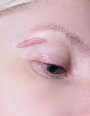 Surgical Scar Revision in Islamabad