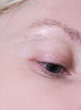 Surgical Scar Revision in Islamabad