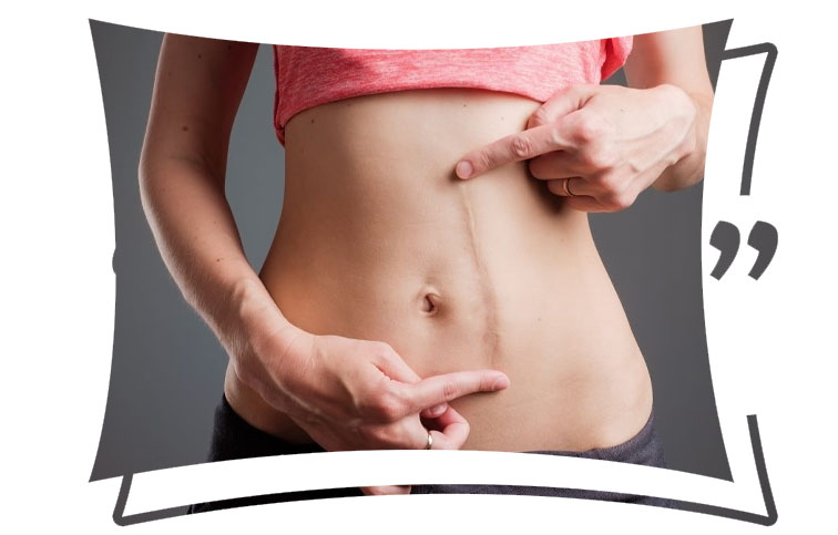 Surgical Scar Revision in Islamabad Cost & Results