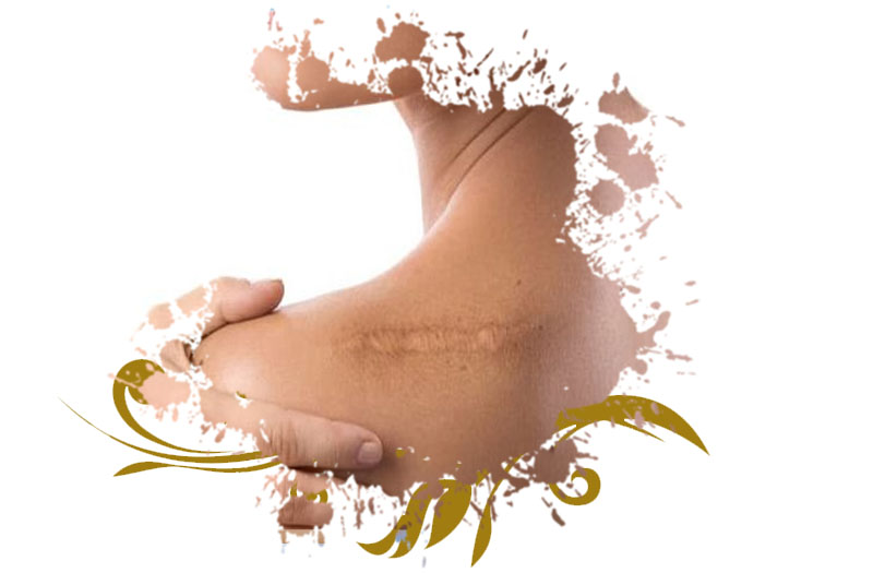 Surgical Scar Revision in Islamabad Glam Aesthetics Cost & Deals
