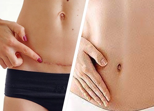 Surgical Scar Revision in Islamabad Glam Aesthetics