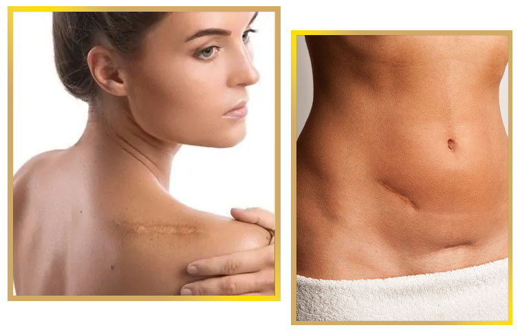 Surgical Scar Revision in Islamabad