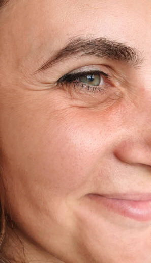 Botox Injections in Islamabad Pakistan