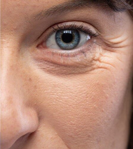 Botox Injections in Islamabad Pakistan Cost