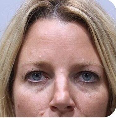 Botox Injections in Islamabad Pakistan Glam Aesthetics Best Deals