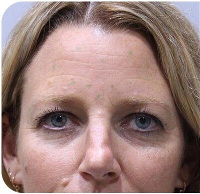 Botox Injections in Islamabad Pakistan Glam Aesthetics Best Deals