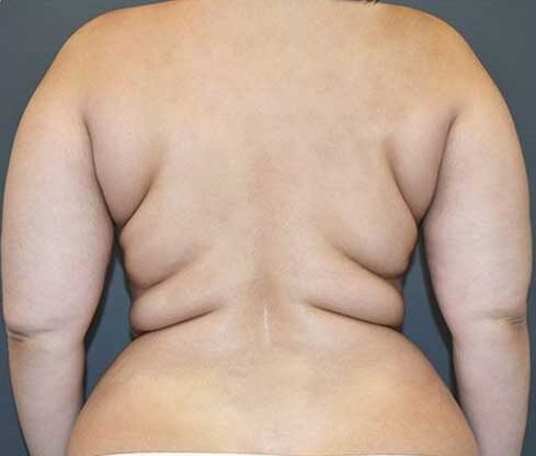 Best Liposuction In Islamabad Pakistan