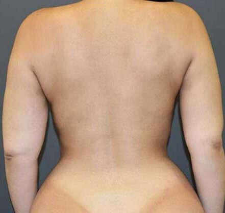 Best Liposuction In Islamabad Pakistan