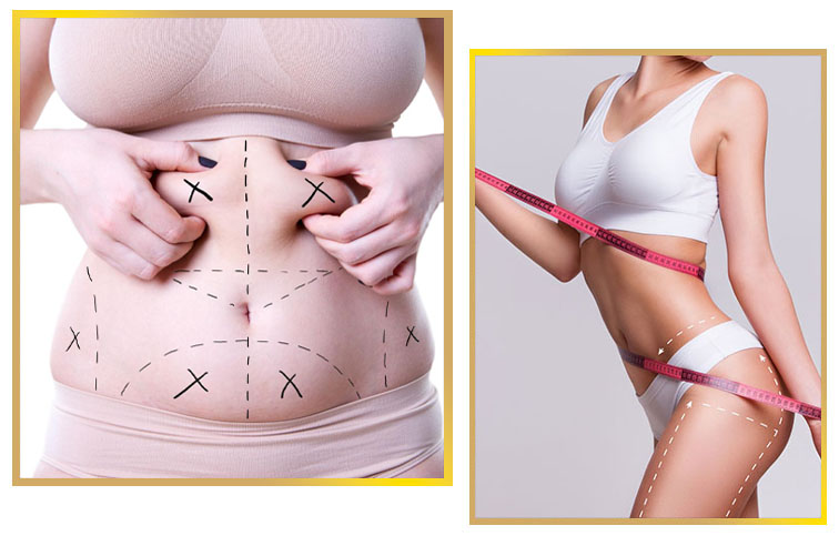 Best Liposuction In Islamabad Pakistan