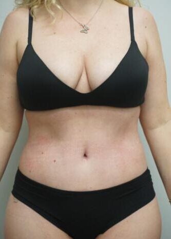 Liposuction Cost In Islamabad Pakistan