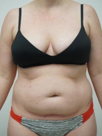 Liposuction Cost In Islamabad Pakistan