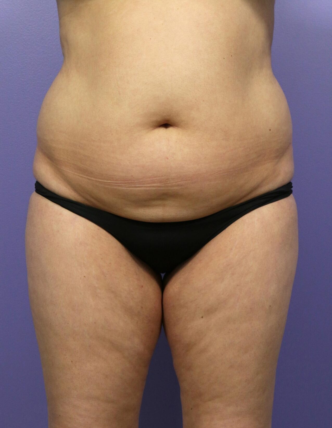 Liposuction In Islamabad Pakistan Cost & Results