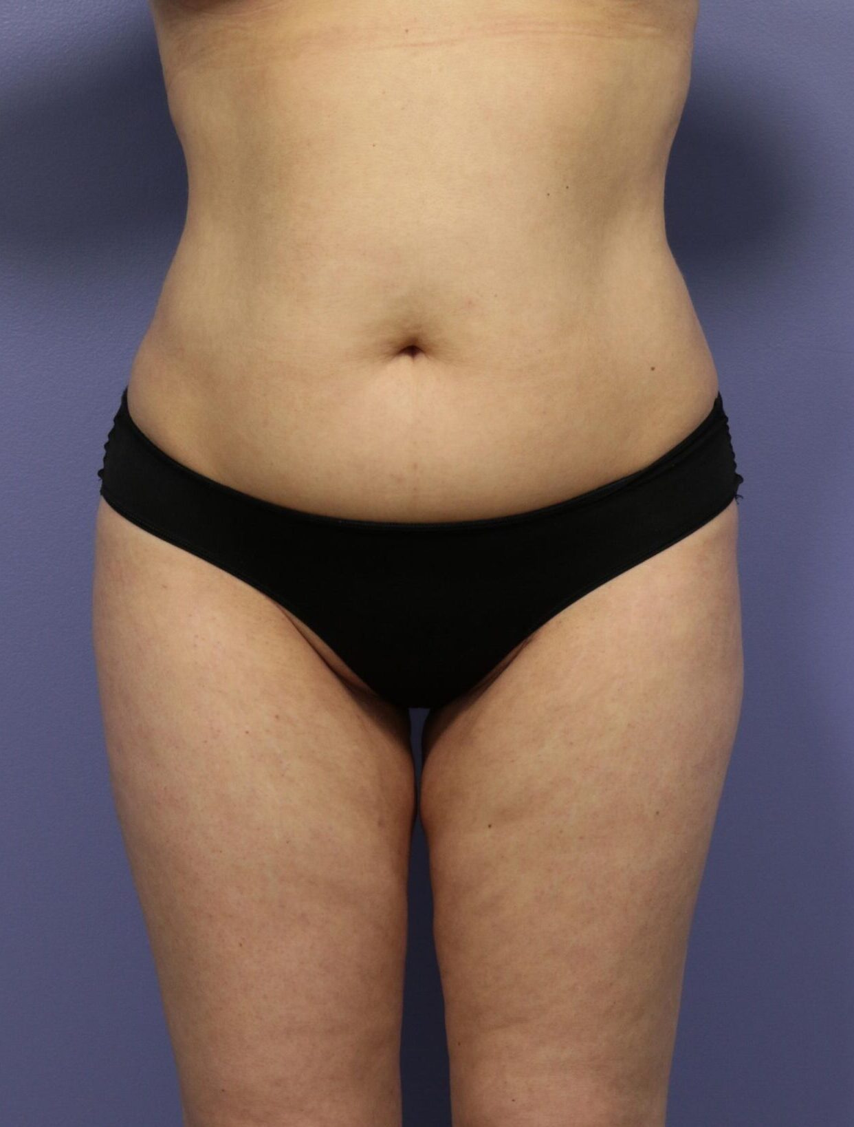 Liposuction In Islamabad Pakistan Cost & Results