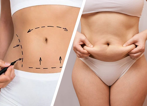 Liposuction In Islamabad Pakistan