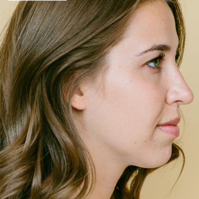 Rhinoplasty Cost in Islamabad Glam Aesthetics