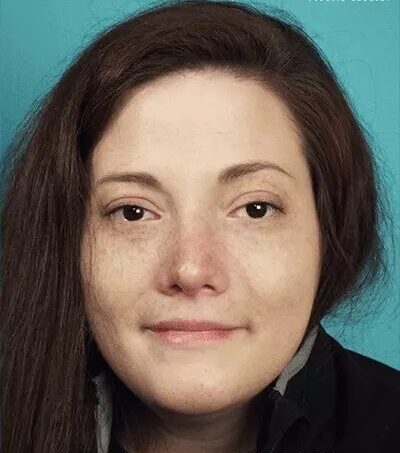 Rhinoplasty Cost in Islamabad Pakistan