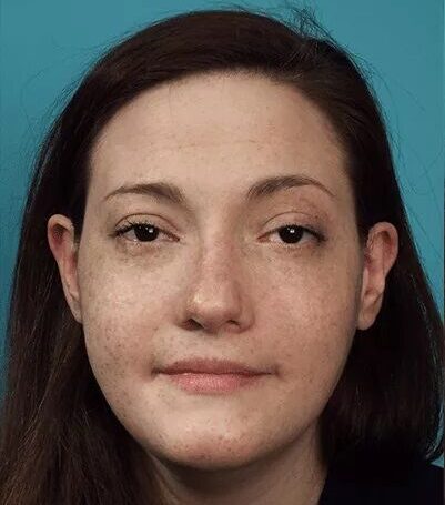 Rhinoplasty Cost in Islamabad Pakistan