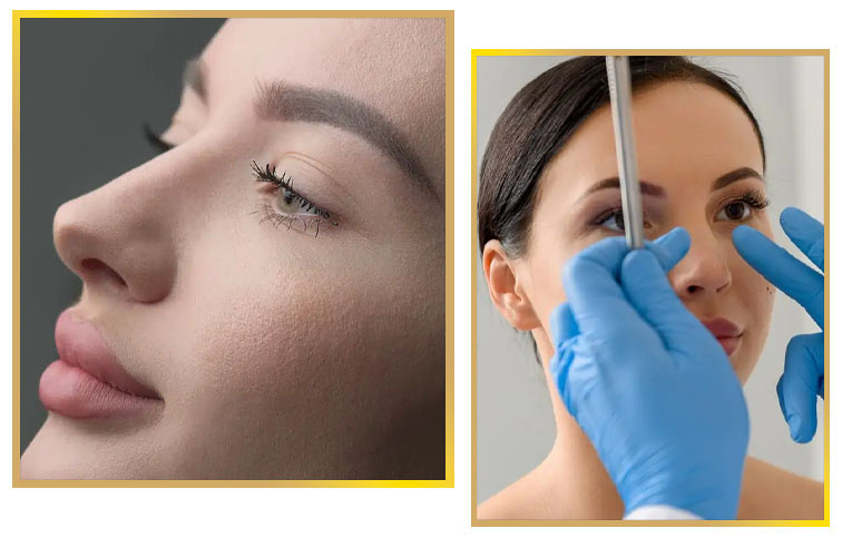 Rhinoplasty In Islamabad Pakistan Glam Aesthetics