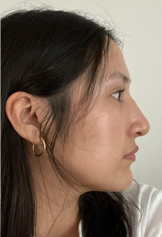 Rhinoplasty in Islamabad Cheapest Price