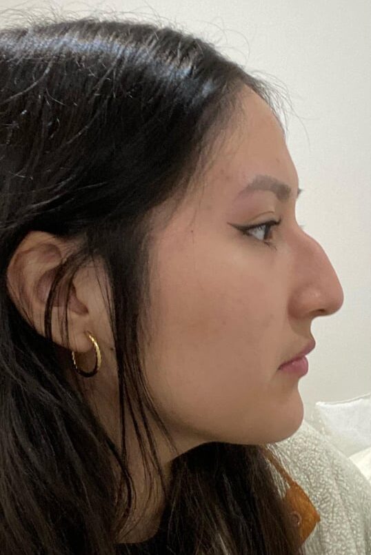 Rhinoplasty in Islamabad Cheapest Price