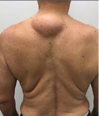 Best Lipoma Treatment in Islamabad