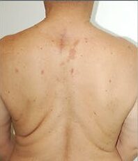 Best Lipoma Treatment in Islamabad