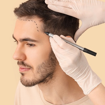 Cheapest Hair Transplant Cost in Islamabad Pakistan FUT FUE Price