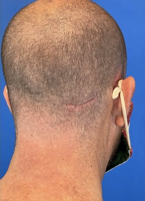 Lipoma Treatment in Islamabad Glam Aesthetics