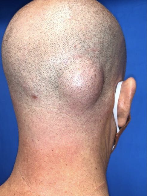 Lipoma Treatment in Islamabad Glam Aesthetics