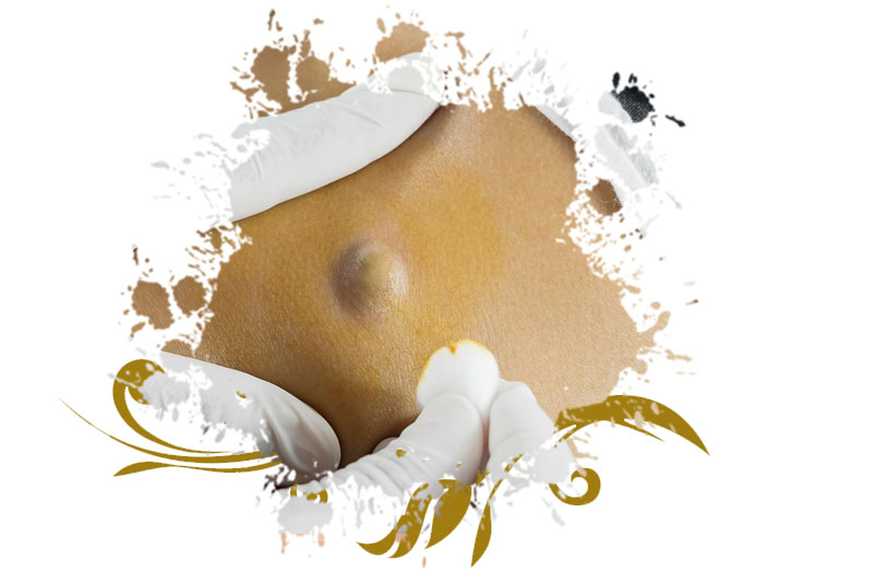 Lipoma Treatment in Islamabad Pakistan Glam Aesthetics