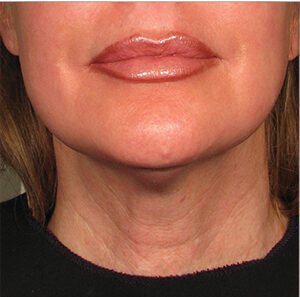 Ultherapy Treatment in Islamabad