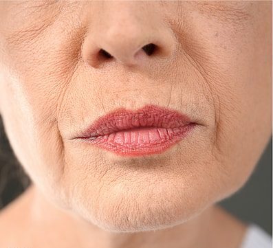 Ultherapy Treatment in Islamabad Glam Aesthetics