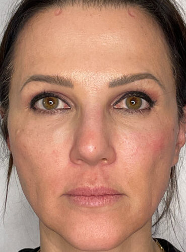 Ultherapy Treatment in Islamabad Pakistan Cheapest Price