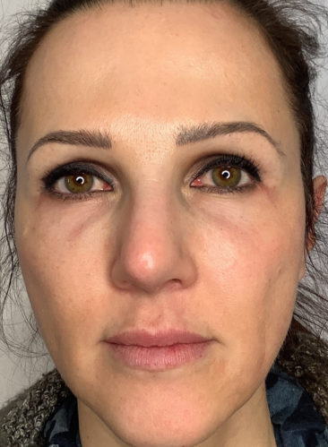 Ultherapy Treatment in Islamabad Pakistan Cheapest Price