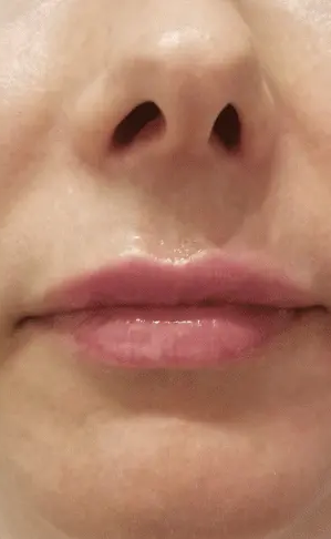 Best Botox Lip Flip in Islamabad Pakistan Cost