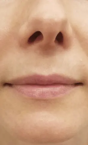 Best Botox Lip Flip in Islamabad Pakistan Cost