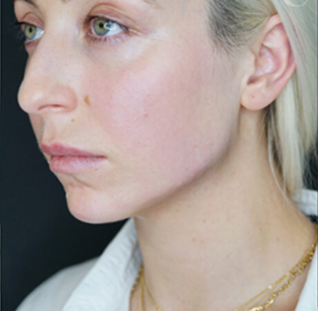 Best Jawline Fillers Injections Price in Islamabad