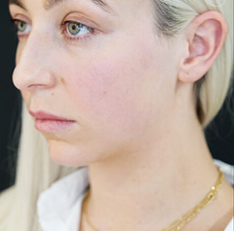 Best Jawline Fillers Injections Price in Islamabad