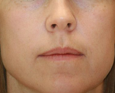 Best Pigmentation Treatment in Islamabad