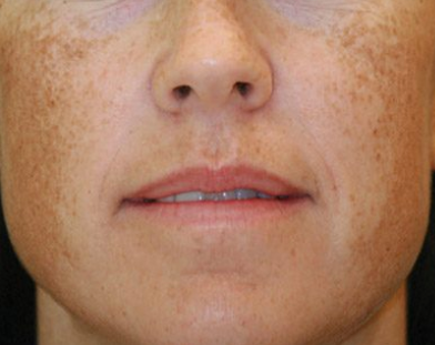 Best Pigmentation Treatment in Islamabad