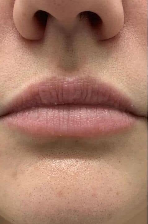 Botox Lip Flip in Islamabad Pakistan Glam Aesthetics