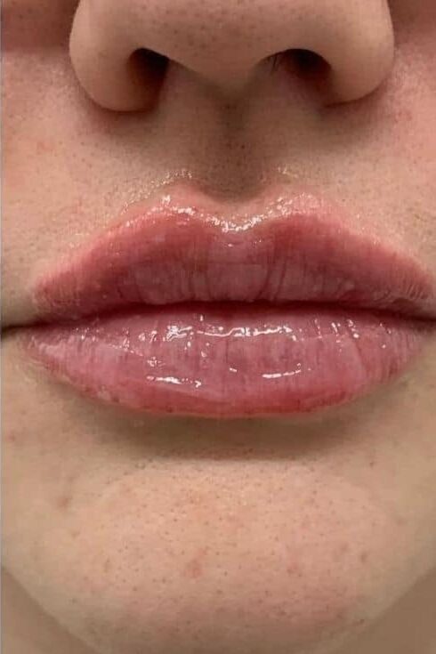 Botox Lip Flip in Islamabad Pakistan Glam Aesthetics