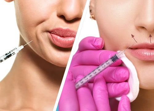 Botox Lip Flip in Islamabad Pakistan