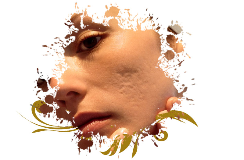 Cheapest Facial Scar Revision in Islamabad